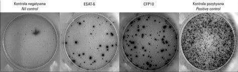 Figure From Interferon Gamma Release Assays In The Diagnosis Of