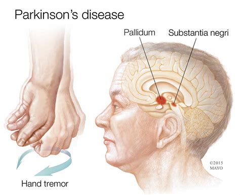 Parkinson S Disease A Progressive Nervous System Disorder Mayo