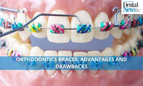 Orthodontic Braces Advantages And Drawbacks