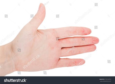 Womans Hand Wounds Eczema Dermatitis Stock Photo 772516753 Shutterstock
