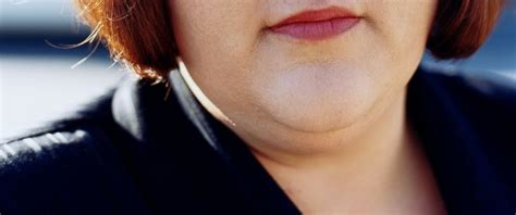Fda Approves Double Chin Eliminator Injection Abc News