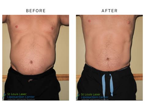 Before And After Abs Emsculpt St Louis Lipo