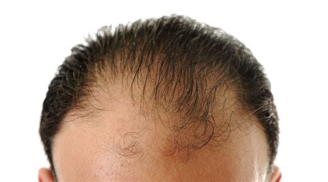 The role of nutrition and diet in treating hair loss represents a dynamic and growing area of inquiry. How A Lack Of Vitamins & Minerals Can Lead To Hair Loss