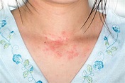 Skin Allergy: Identifying 3 Common Skin Rashes