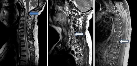 Preoperative T2 Weighted Sagittal Mri Of The Cervical And Thoracic