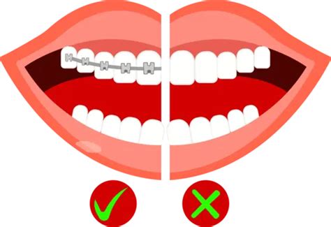 Comparison Of The Effect Braces On Teeth Vector Comparison Of The