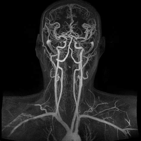 Magnetic Resonance Angiogram Of The Brain Magnetic Resonance