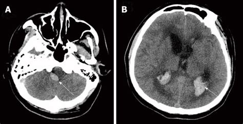 Axial Brain Computed Tomography Shows Hemorrhage Of The Right Pons A
