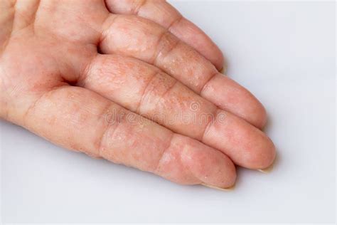 Seborrheic Dermatitis On Fingers Atopic Dermatitis Symptoms Images
