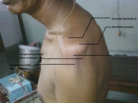 Subluxation Of Shoulder Joint Gleno Humeral Joint Best Treated By