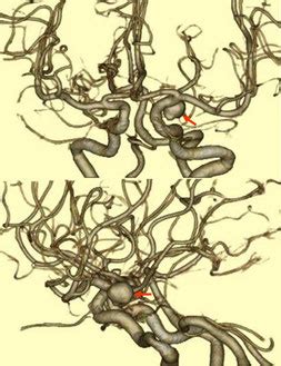 어서오세요 실력지상주의 교실에 15권(2학년편 4권) 선탈주. くも膜下出血 - moriyama-neurosurgical-clinic ページ!