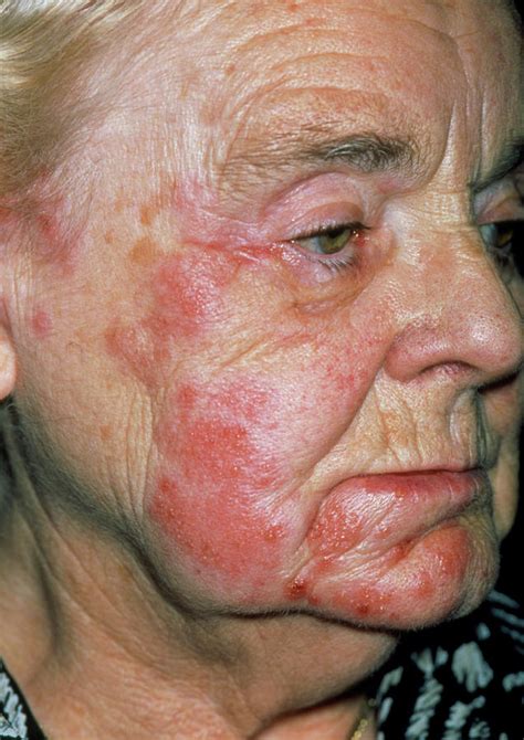 Herpes Zoster Rash On An Elderly Womans Face Photograph By Dr P