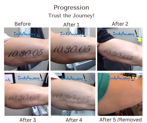 Progression Of Tattoo Removal Inkaway Laser Tattoo Removal
