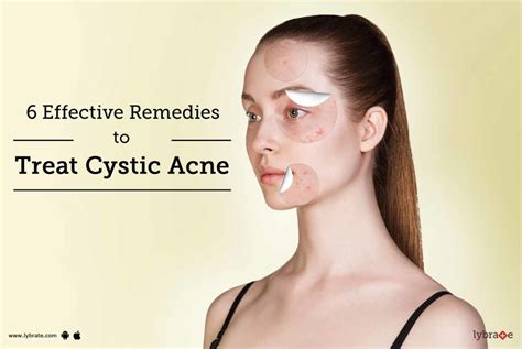 6 Effective Remedies To Treat Cystic Acne By Dr Shreyas Bansal Lybrate