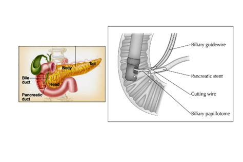 Endoscopic Retrograde Cholangio Pancreatography Ercp