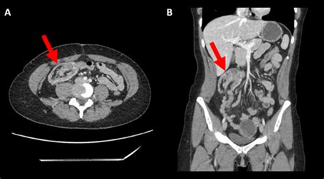 Adult Intussusception Secondary To Covid 19 Infection A Case Report