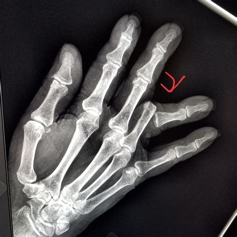 Xray Broken Finger