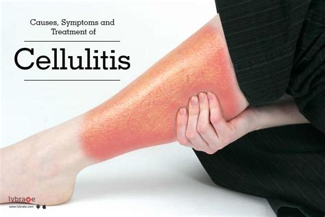 Cellulitis Causes Signs Symptoms And Treatment By Dr Sandeep Gupta The Dermatologist