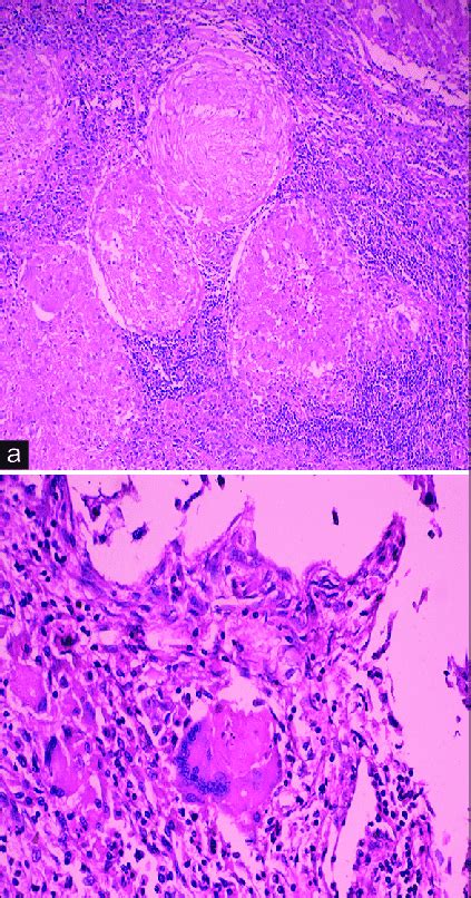 Histopathological Images Of Tuberculosis Of The Axillary Lymph Node