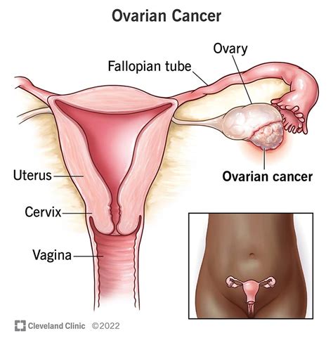 Ovarian Cancer Symptoms Diagnosis And Treatment