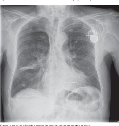 Figure 2 From Pneumothorax After Pacemaker Implantation Localized