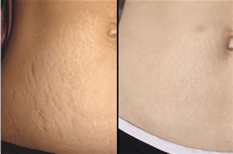 Stretch Marks Learn Why They Happen Natural Remedies Waxelene