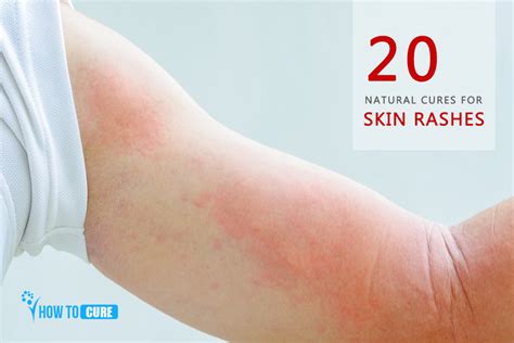 20 Natural Cures For Skin Rashes Home Remedies For Skin Rashes