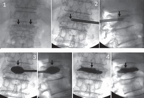 Intraoperative Radiographs Of Performed Kyphoplasty On The Facial
