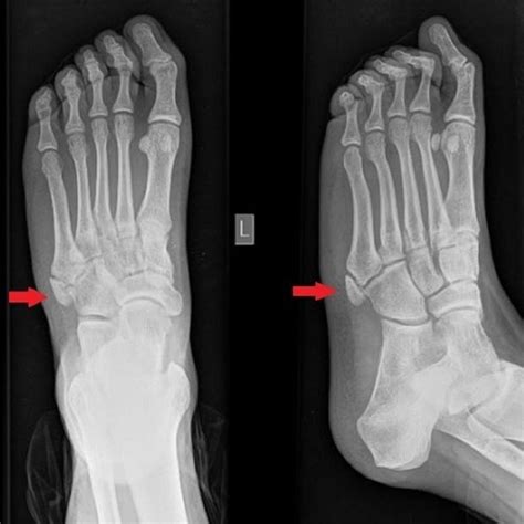 Plain Radiograph Ap And Lateral Oblique Of The Left Foot Reveals The