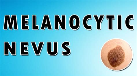 Melanocytic Nevus Treatment Symptoms And Causes Dermatology Course