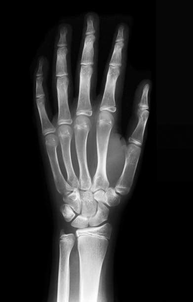2600 Wrist Xray Stock Photos Pictures And Royalty Free Images Istock