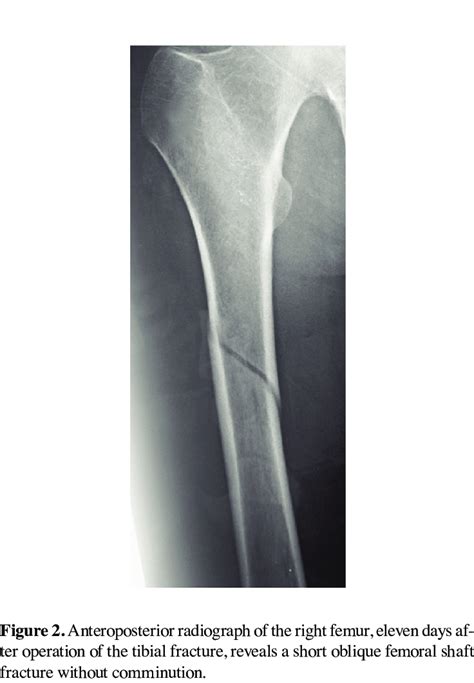 Anteroposterior Radiograph Of The Left Tibia After A Motor Vehicle