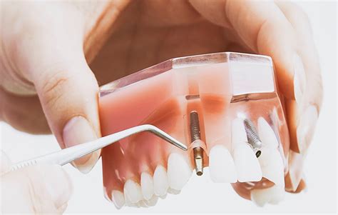 Instant quality results at searchandshopping.org! Dental Implants Clinton Township MI | Dental Implant Dentist Clinton Township Michigan