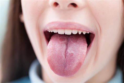 Tongue Peeling Causes Pregnancy White And Treatments American Celiac