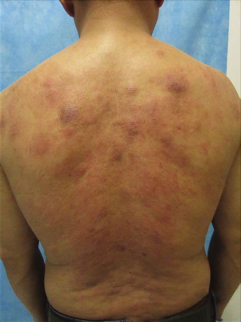Generalized Asymptomatic Erythematous Nodules And Plaques Indian