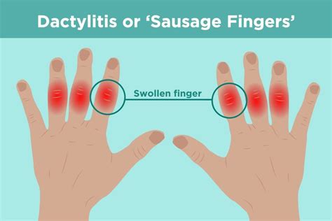 What Is Dactylitis Understanding Causes Symptoms And