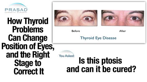 How Thyroid Eye Disease Graves Disease Affects Eye And Eyelid Position Youtube