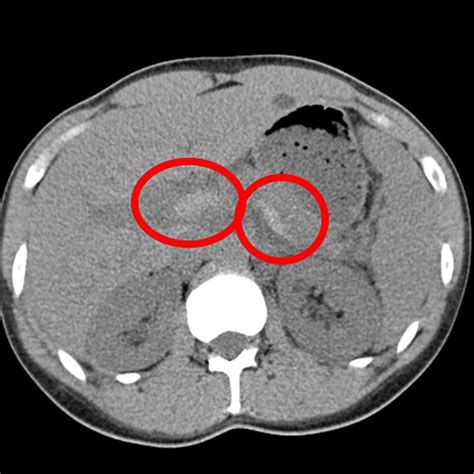 Ct Scan Of The Abdomen Showing Splenic And Portal Vein Thrombosis