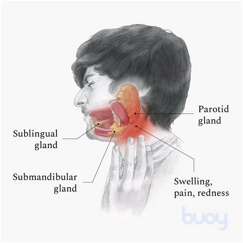 Reanimar Papa Oficiales Blocked Salivary Gland Treatment Destino