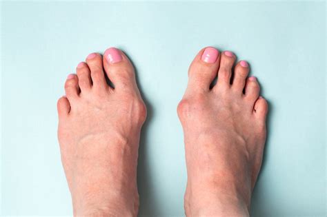 Hallux Valgus Quels Sont Les Traitements Offerts Pour Le Traiter