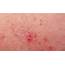 The Best Scabies Treatment  Healthy Living