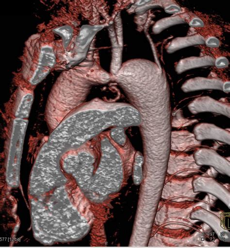 Coarctation Of The Aorta With Increased Flow Through The Internal