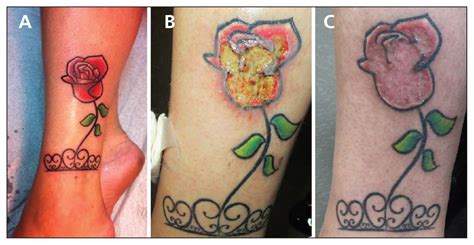 Psoriasis And Tattoos A Comprehensive View Alla Winston