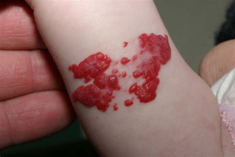 Hemangioma Hemangioma Of Skin Spine Liver Causes And Treatment