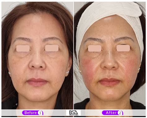 Hifu Hifu Treatment Price Before And After Photos Recovery Time