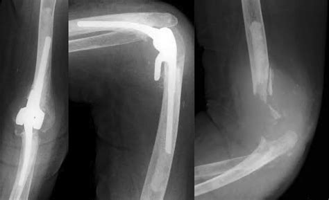 Outcomes Of Semiconstrained Total Elbow Arthroplasty Performed For