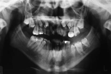 Oral Health Management Of A Patient With 47xyy Syndrome Bmj Case Reports