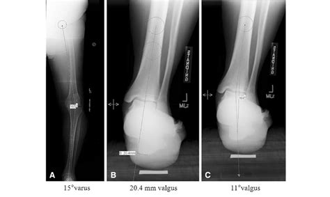 A C A Mechanical Axis Alignment Shows Varus Knee Deformity B