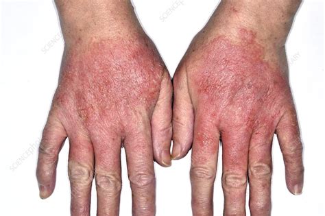 Infected Dermatitis Stock Image C0269172 Science Photo Library