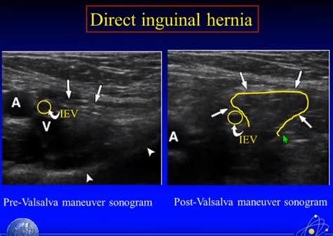 Ultrasound To Diagnose Inguinal Hernia Carles Pen